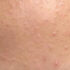 Understanding and Treating Closed Comedones