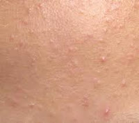 Understanding and Treating Closed Comedones