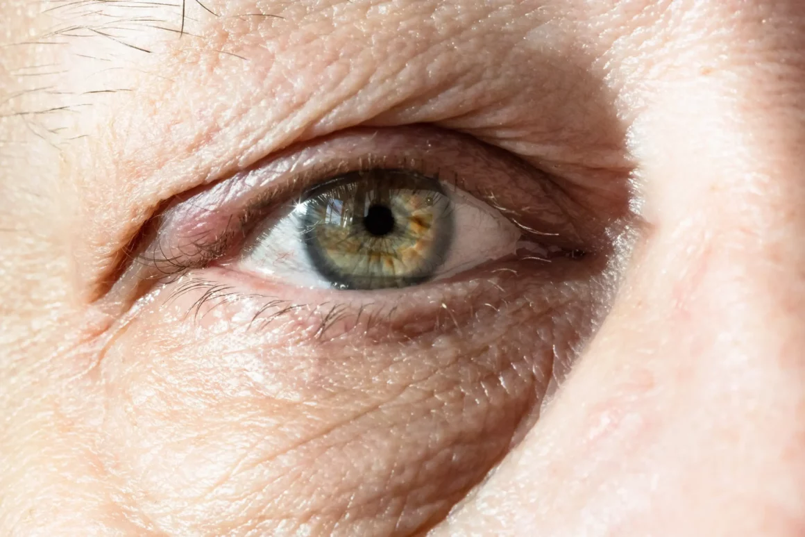 male-eye-with-thickening-on-eyelid-from-chalazion-2024-10-13-14-00-59-utc (1) (1) Understanding the Difference Between Under-Eye Bags and Circles
