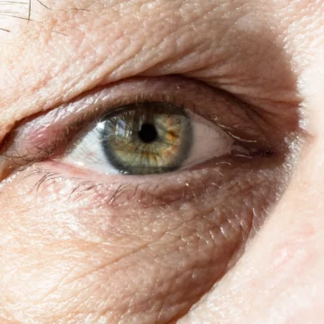 Understanding the Difference Between Under-Eye Bags and Circles