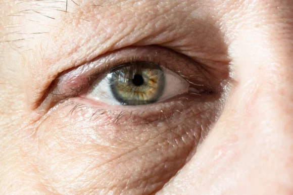 Understanding the Difference Between Under-Eye Bags and Circles