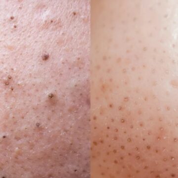 Unraveling the Mystery of Sebaceous Filaments