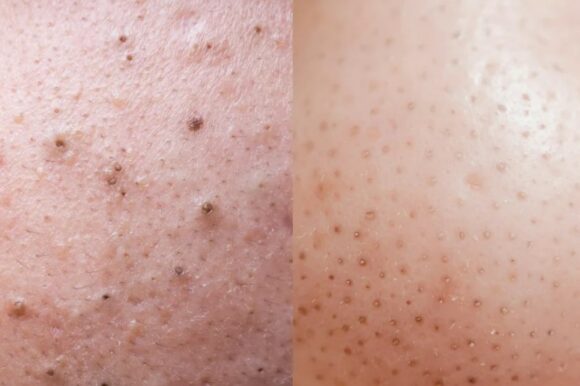 Unraveling the Mystery of Sebaceous Filaments