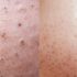 Unraveling the Mystery of Sebaceous Filaments